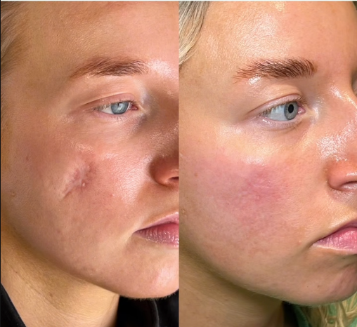 Elavae™ Silicone Scar Sheets